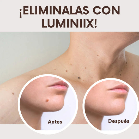 LUMINIIX - Eliminador de verrugas 60 ml